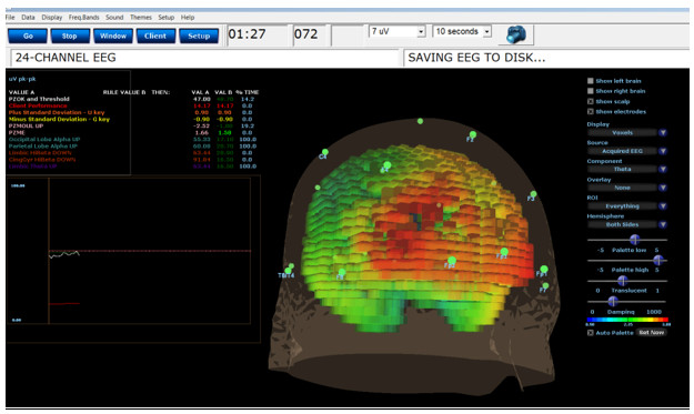 Tratamiento TDAH / déficit de atención con Neurofeedback en Barcelona