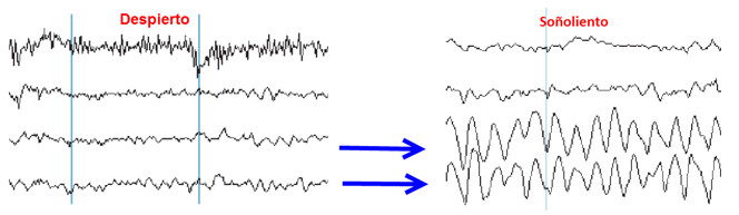 tratamiento del insomnio con neurofeedback