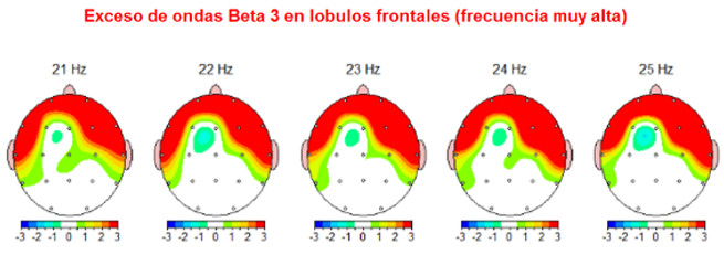 Tratamiento ansiedad con Neurofeedback en Barcelona