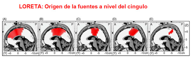 Tratamiento ansiedad con Neurofeedback en Barcelona
