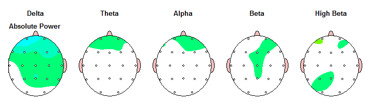 tratamiento-heroina-neurofeedback