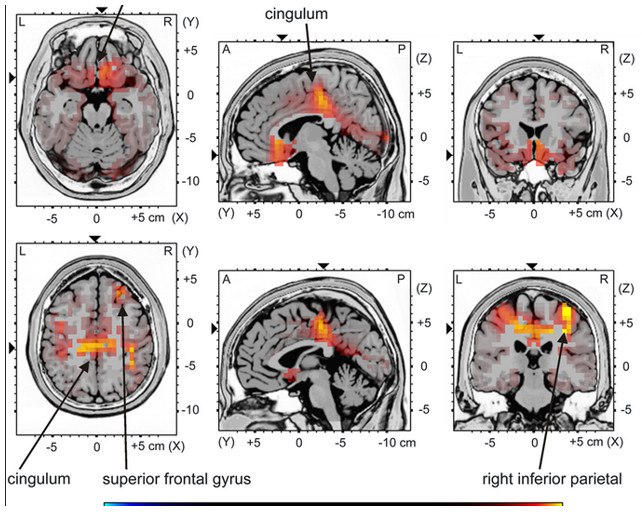 Es una tomografía, lo que significa que se pueden ver las distintas áreas del cerebro por secciones o cortes.