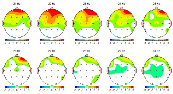 Tratamiento migrañas Neurofeedback  Barcelona