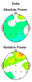 Tratamiento migrañas y dolores de cabeza con Neurofeedback  Barcelona