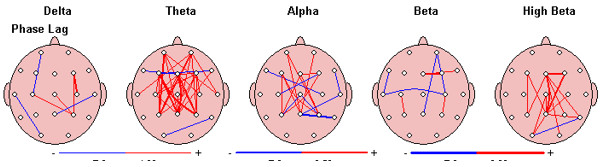 tratamiento-adiccion-cocaina-neurofeedback