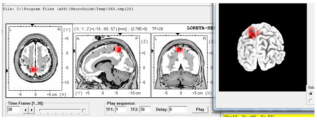 tratamiento-adiccion-cocaina-neurofeedback