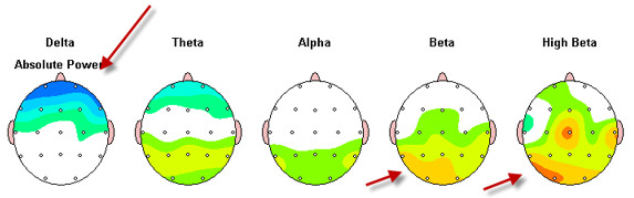 tratamiento-adiccion-cocaina-neurofeedback