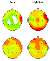 tratamiento-heroina-neurofeedback