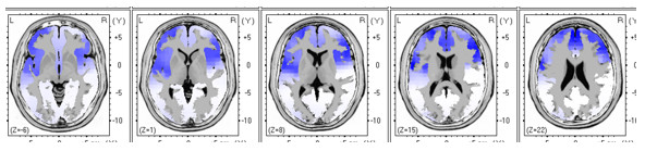 tratamiento-alcoholismo-neurofeedback