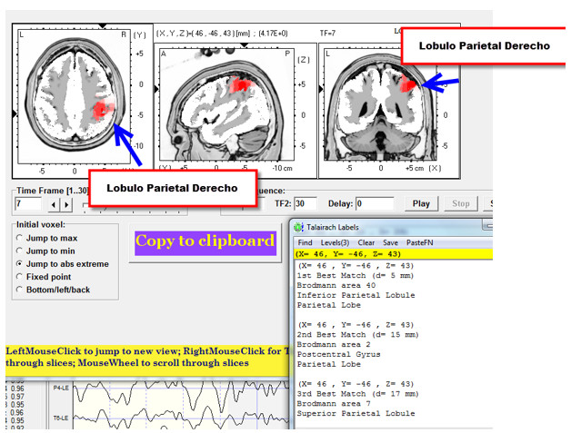 tratamiento-lesiones-cerebrales-neurofeedback