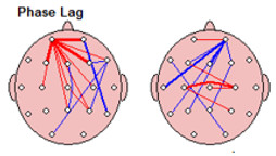 lesiones-cerebrales-neurofeedback