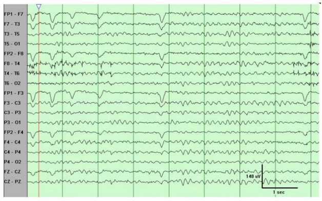 tratamiento-heroina-neurofeedback