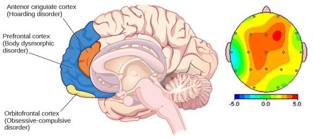 tratamiento-trastorno-obsesivo-compulsivo-neurofeedback