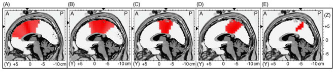 tratamiento-trastorno-obsesivo-compulsivo-neurofeedback