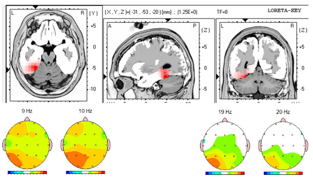 El Neurofeedback también mejora las conexiones