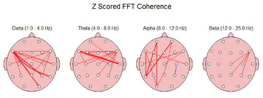 El Neurofeedback también llamado EEG Biofeedback 