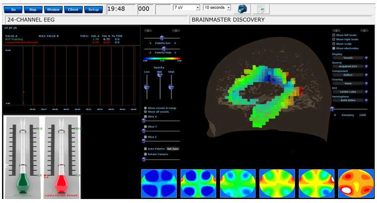 tratamiento-cannabis-marihuana-porros-neurofeedback