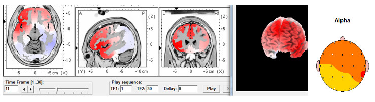 tratamiento-cannabis-marihuana-porros-neurofeedback