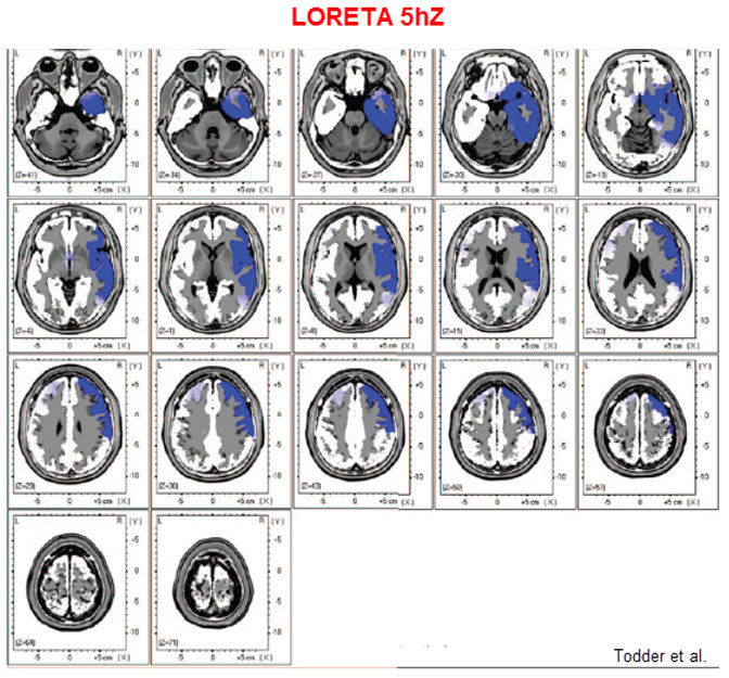 tratamiento-trauma-emocional-neurofeedback